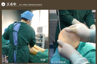 【假体法乳房再造术】假体法乳房再造术手术多少钱_法