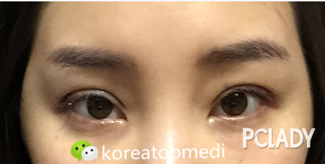 【韩国整形案例】眼部凹陷的眼部脂肪填充_P