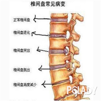 腰椎间盘突出三四年,还有机会可以治疗好吗?
