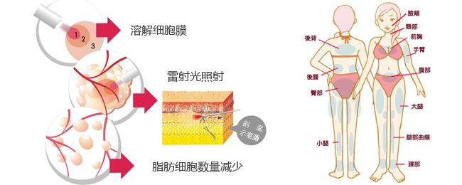 【标靶震波溶脂】标靶震波溶脂手术多少钱_标