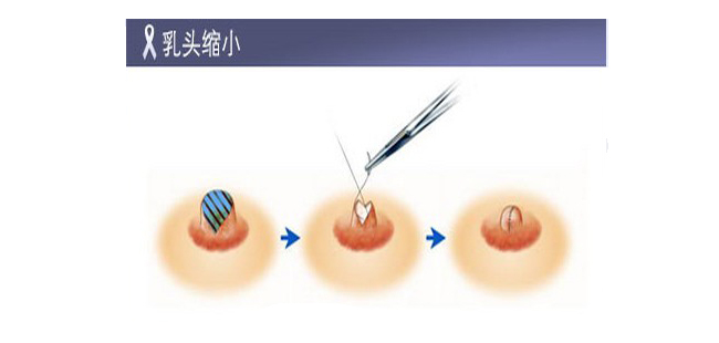 双环法乳房下垂矫正术乳房塑形悬吊法半侧乳头切除缩小乳头小