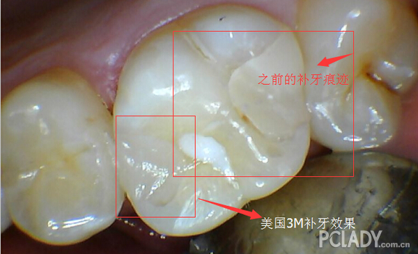 "一牙三色"惊呆患者 完美补牙效果获赞