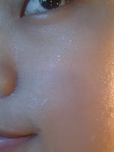 粉刺是什么样的一个状态 12821206263530790.jpg