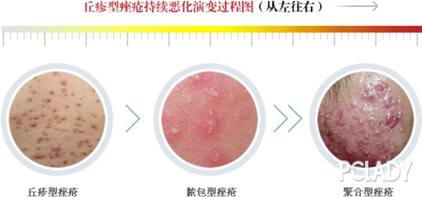 家弘老师派福利:别让青春,"痘"你玩儿