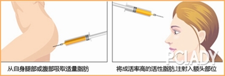 打造锥子脸 四大整形项目很给力