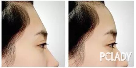 自体脂肪丰额头抽脂疼吗?