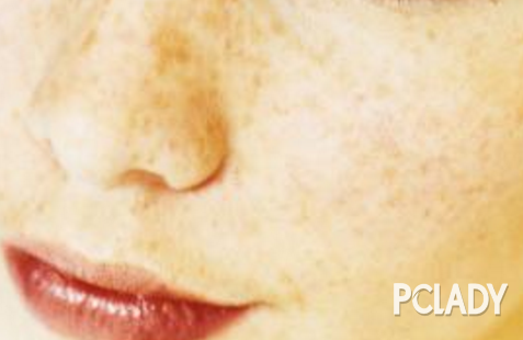 什么是黑色素沉淀 82926411_1523776397636_600.png