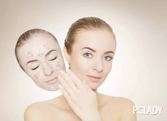 激素脸修复需要多久 激素脸的恢复周期一般需要多久
