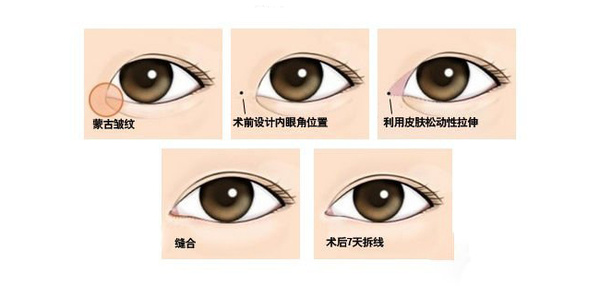 开眼角图解 5638332_1429423187535_600x2000.jpg